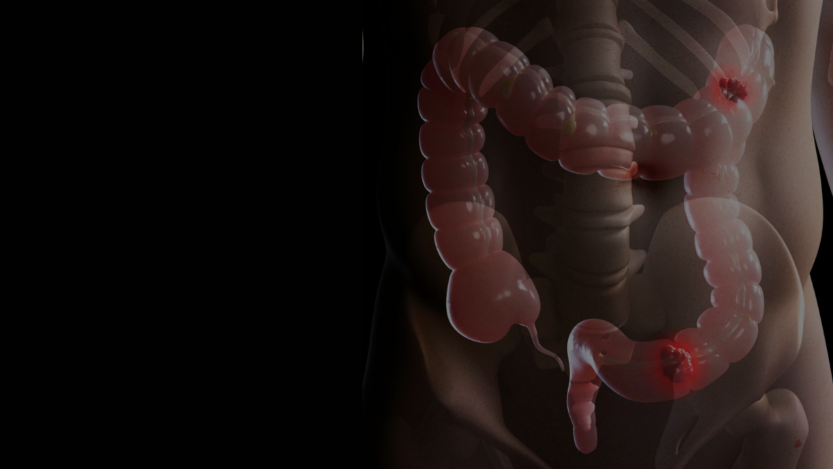 Conduta nutricional em diferentes fases das doenças inflamatórias intestinais 